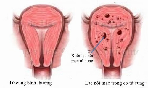 Lạc nội mạc trong cơ tử cung: Nguyên nhân và giải pháp điều trị